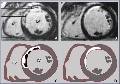 🧵 Cardiac MRI (CMR) excels in evaluating myocardial injury and function post-myocardial infarction (MI), offering detailed tissue characterisation that enhances diagnosis, management, and prognosis. Plus, the images are gorgeous!