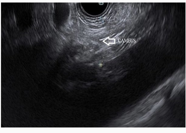 Sharing a promising method for assessing and possibly sampling visceral fat for metabolic disease risk stratification using Celiac Artery Mesenteric Fat on EUS (CAMEUS). It's a simple tool that can be integrated into EUS procedures, offering new insights on patients’ metabolic…