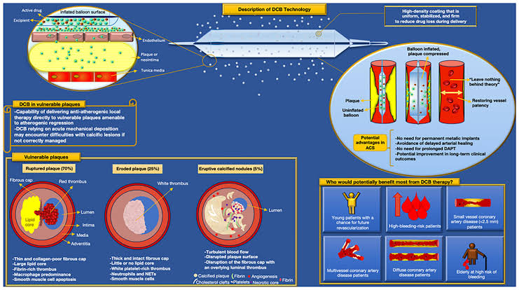 🔴 Drug-Coated Balloon in Acute Coronary Syndromes: Ready for the Prime Time?  #2024Review 

link.springer.com/article/10.100…
 #MedX #medEd #MedEd #CardioEd #CardioTwitter #MedTwitter #Cardiology #cardiology #medtwitterWhat #meded #FOAMed #cardiotwiteros