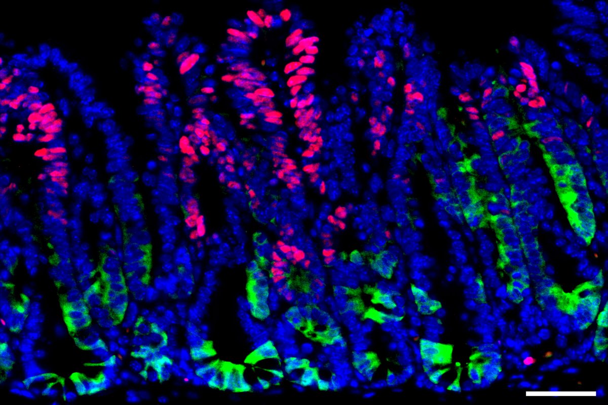 In these intestinal tumor cells, the Sox17 protein is shown red. MIT researchers have found that when tumor cells turn on the Sox17 gene, it helps them evade immune detection, in part by turning off the expression of a protein called Lgr-5, shown in green. mitsha.re/WxNw50QKj0l
