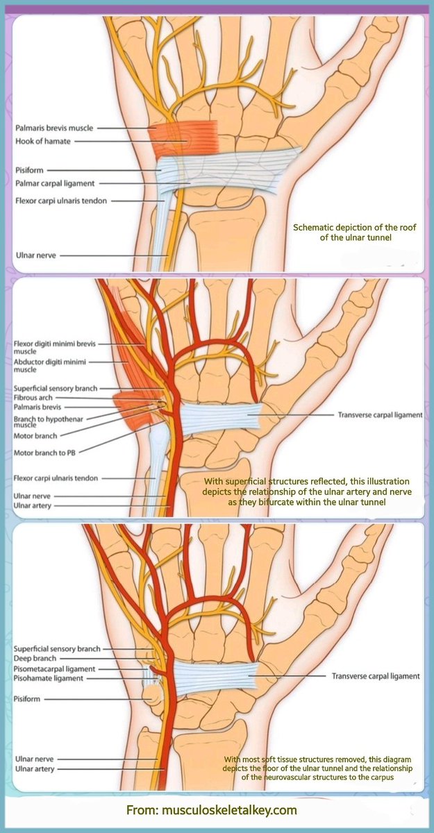 Floor of ulnar tunnel & relationship of neurovascular structures👍 3 types of Guyon canal syndromes: Type 1 Proximal to bifurcation of nerve=Mixed motor & sensory Type 2 Surrounds deep motor branch=Motor only Type 3 Surrounds superficial sensory branch=Sensory only