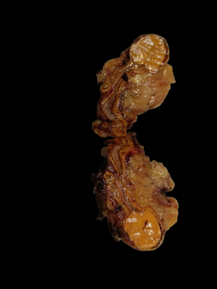 drsunitim's tweet photo. 40 year old male . Incidently detected well circumscribed nodule in adrenal gland.
#endocrine #endopath #adrenal #frcpath #pathTwitter #pathology #pathologist https://t.co/o6pm8C70uR