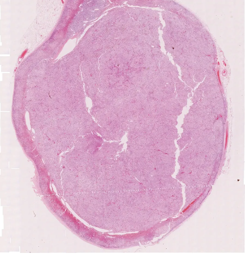 drsunitim's tweet photo. 40 year old male . Incidently detected well circumscribed nodule in adrenal gland.
#endocrine #endopath #adrenal #frcpath #pathTwitter #pathology #pathologist https://t.co/o6pm8C70uR