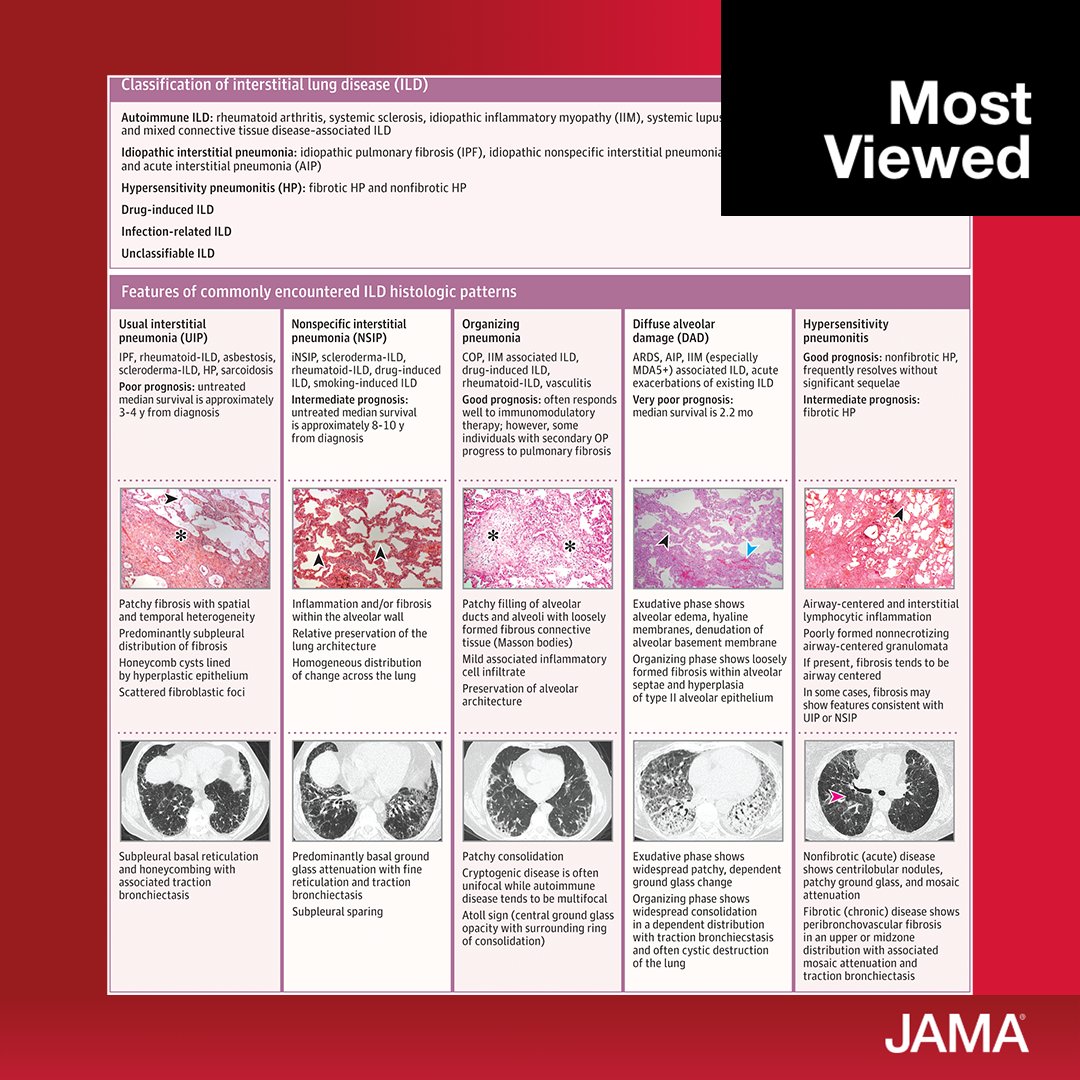Most viewed in the last 7 days from @JAMA_current: Review summarizes current evidence regarding the diagnosis and treatment of interstitial lung disease. ja.ma/4d9x7eF