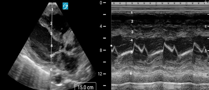 POCUS Quiz/Clip of the Week #36 🎥 Q1: What type of ultrasound is shown on the right? Q2: Can you name structures 1-6? Q3: What CPT code is used for this type of limited exam? Join the @IUPCCM Click the link to take this week's quiz! 🚀📝 forms.office.com/r/YusRG6ES8k @NephroP…