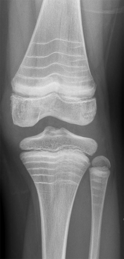 What is the diagnosis? Inherited bone pathology. What are the lines #MedTwitter