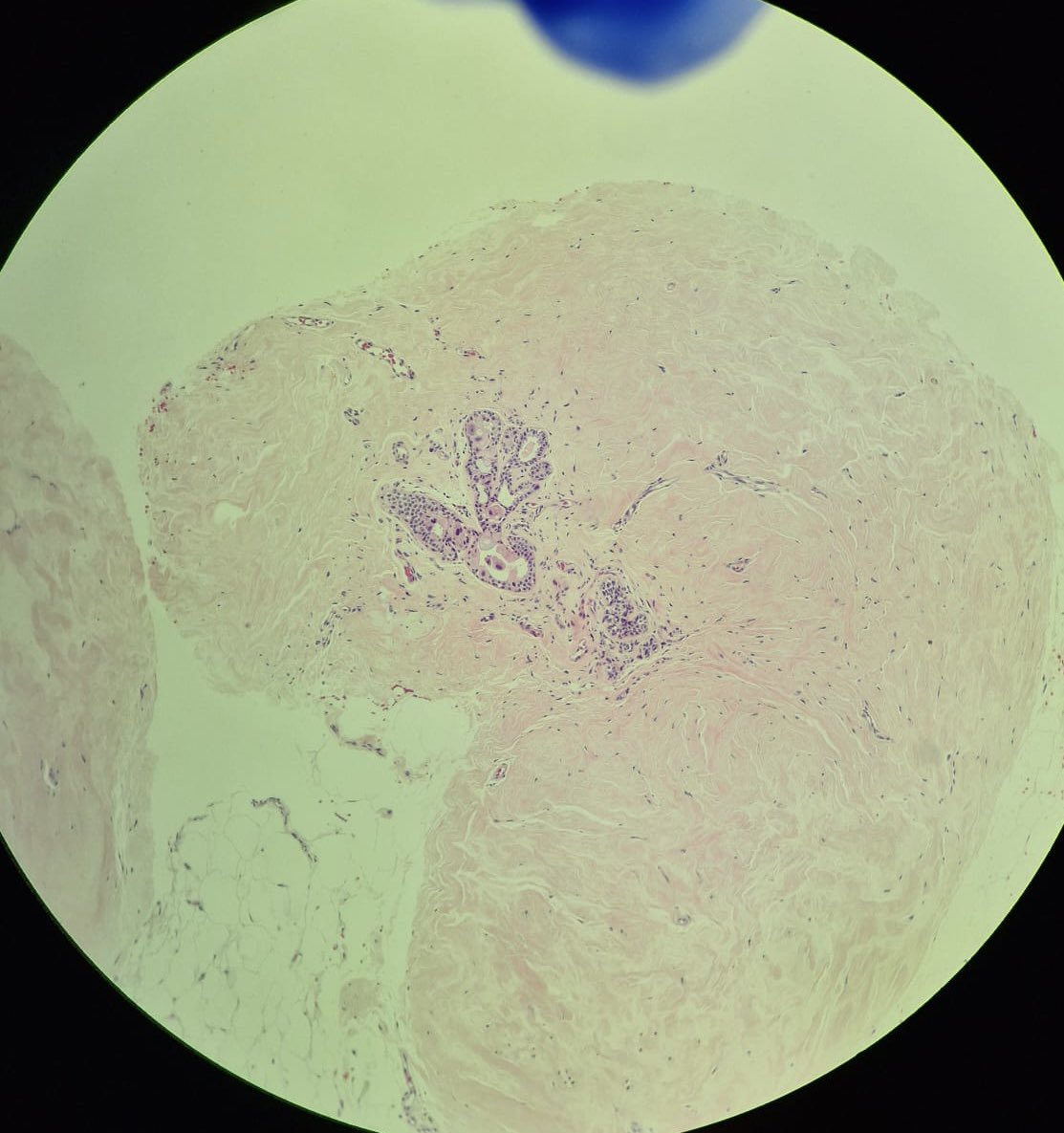 A 45-year-old female patient was initially diagnosed with a HER2-positive, invasive ductal carcinoma of the left breast in 2021. The patient was treated with lumpectomy, axillary dissection, followed by CRT. USG revealed some areas suspicious of fat necrosis.