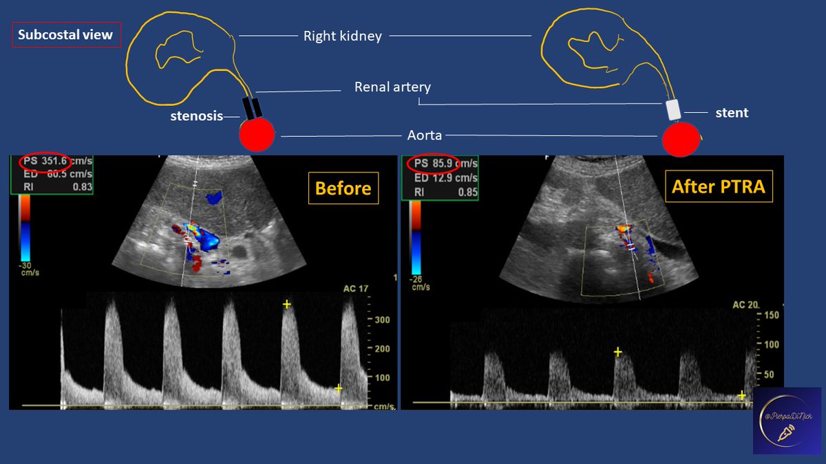 #POCUS #renaldoppler An example of a right single kidney with high-degree renal artery stenosis, before and after Percutaneous Transluminal Angioplasty & stent placement 👉successful outcome with complete normalization of PW Doppler velocity & creatinine improvement🫂