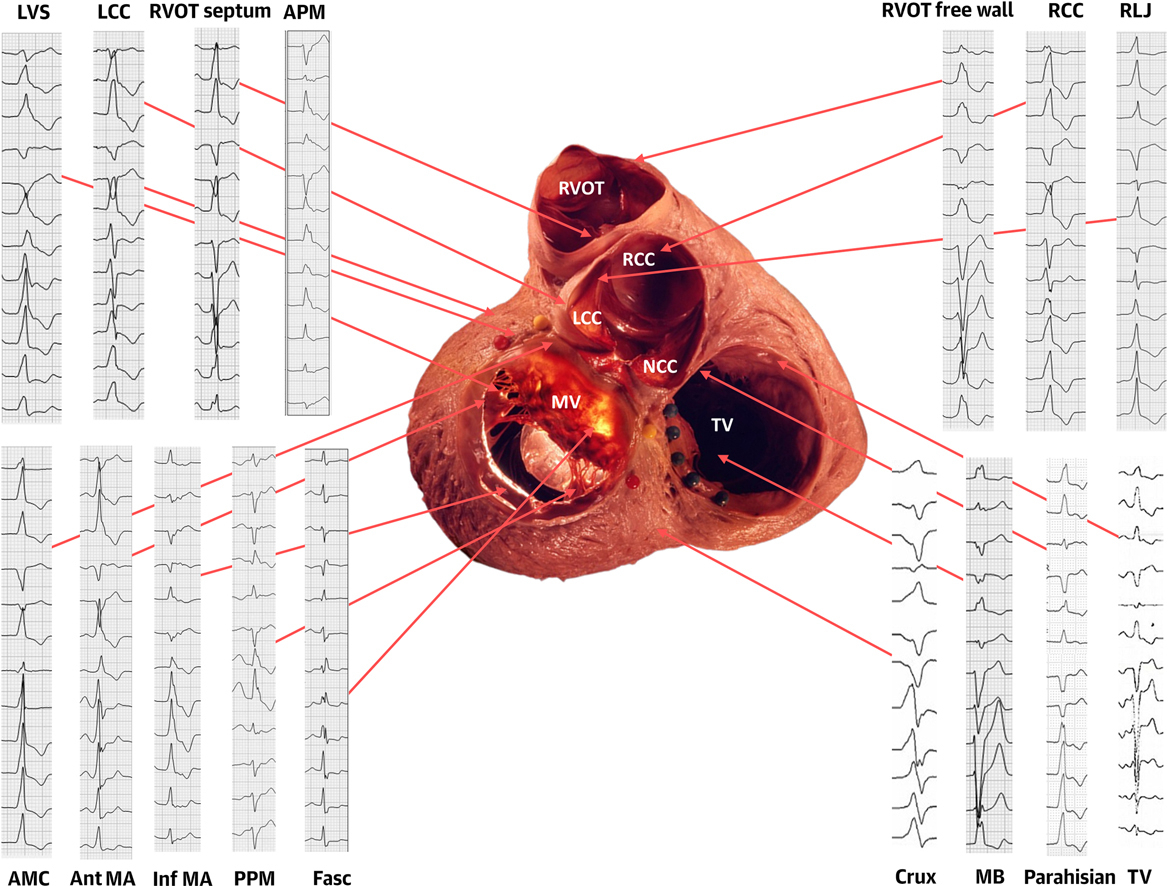 🆕 Mapeo y ablación de las extrasístoles ventriculares: ¿Sabes reconocer de dónde vienen?

📕 JACC Clin Electrophysiol
📁 cardioteca.com/arritmias/5717…