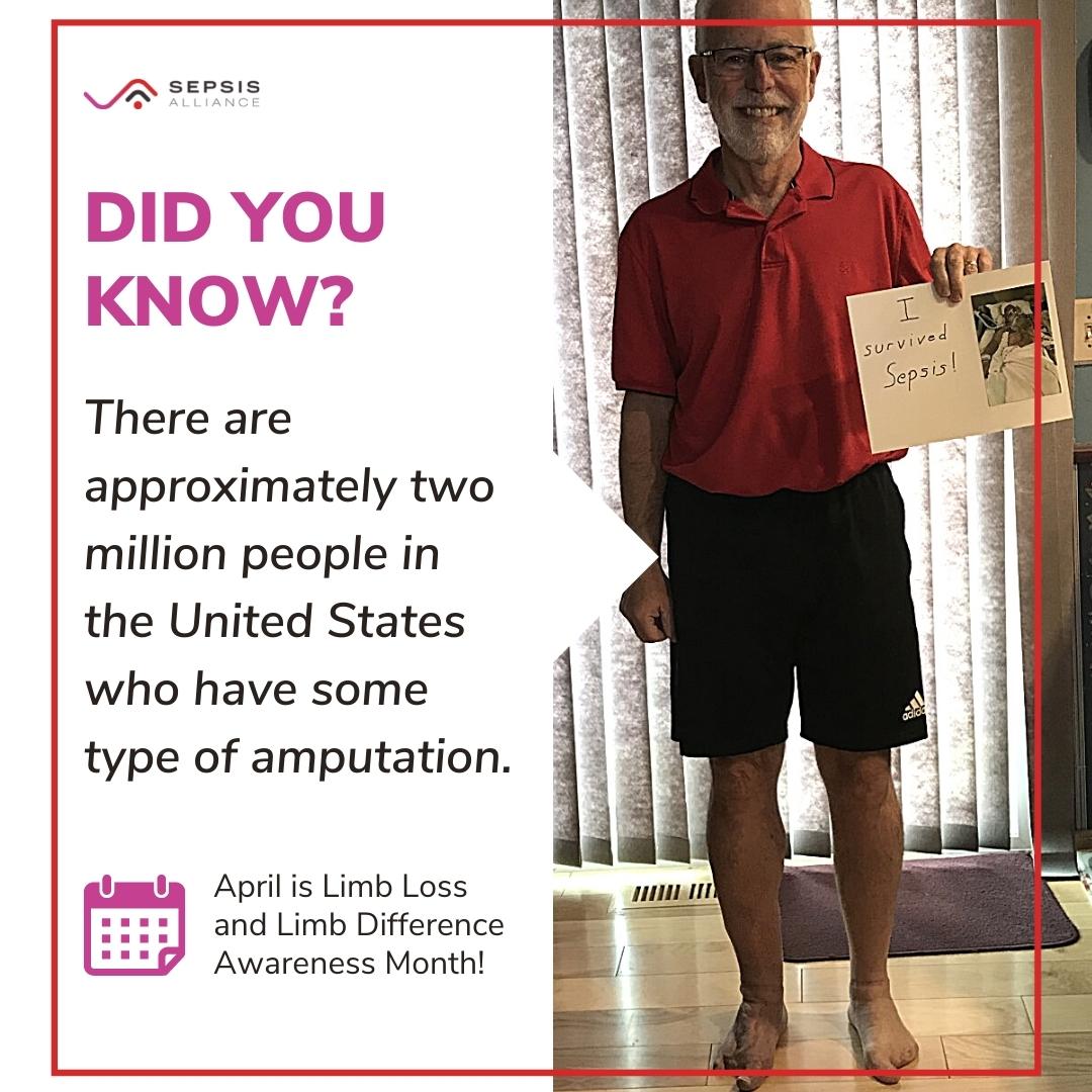 According to @AmputeesUSA, approximately two million people in the United States have some sort of amputation. This includes #sepsis survivors like Don, who lost 7 of his toes after a group A strep infection rapidly progressed to life-threatening sepsis. sepsisalliance.info/Amputations