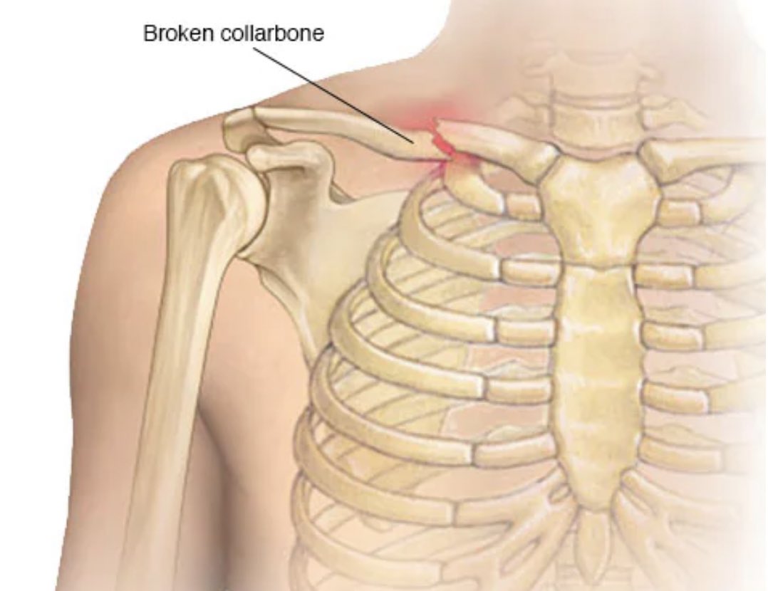 Broken collarbone 😔