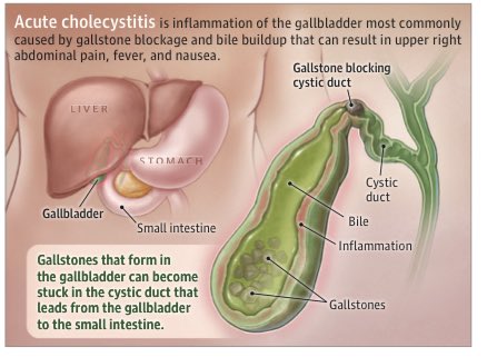 PROGRESIÓN DE COLECISTITIS AGUDA 🤢🤮

 #SoMe4PedSurg