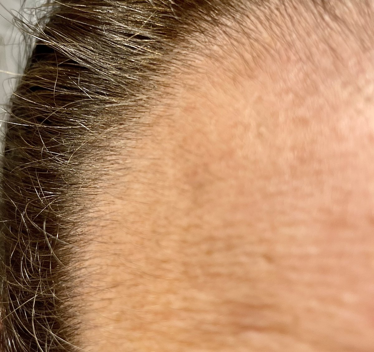 Two weeks in from adding minoxidil (I also have a finasteride script) and the baby hairs are starting to show 😃