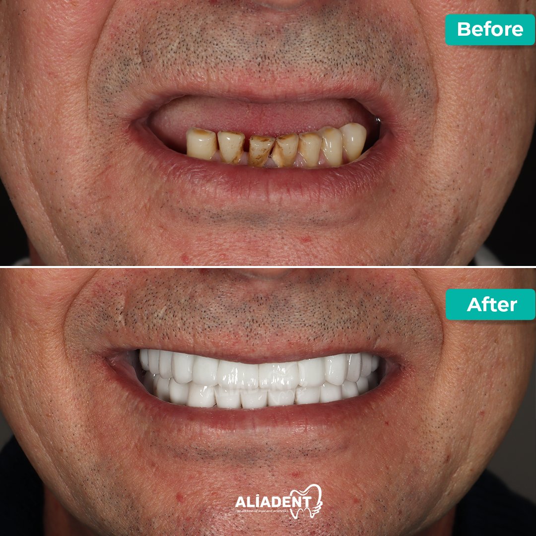 Experience great transformations at Aliadent! Our before and after photos show our excellent results. Rediscover your smile with Aliadent. 

For more information, visit aliadent.com/en

#hollywoodsmile #aestheticsmile #smiledesign