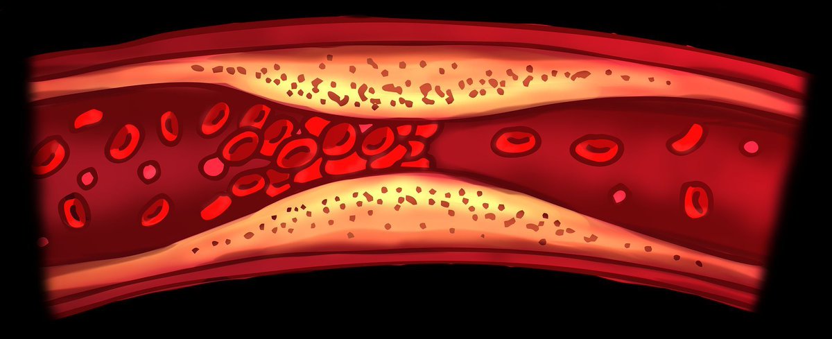 Venous thromboembolic event Risk study in 1854 SLE pts vs controls (12,107) from 1985–2015 in W Australia. VTE affected 12.8% SLE pts; 6 fold higher than controls (RR 6.6). Risk factors: aPL(aHR 4.24), serositis (2.7), nephritis (1.75), low Plts (1.65) buff.ly/3QmAzsG