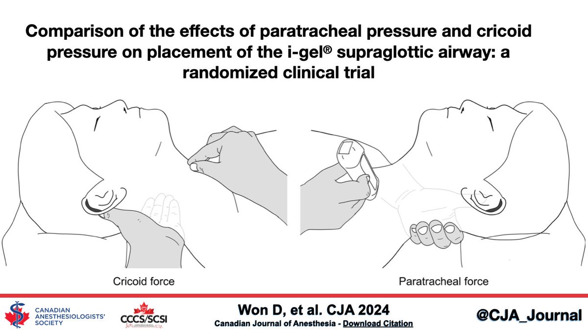 Comparison of the effects of paratracheal pressure and cricoid pressure on placement of the i-gel® supraglottic airway: a randomized clinical trial - Canadian Journal of Anesthesia #CJA #CJA2024 #Anesthesia #Anesthesiology rdcu.be/dDXNf