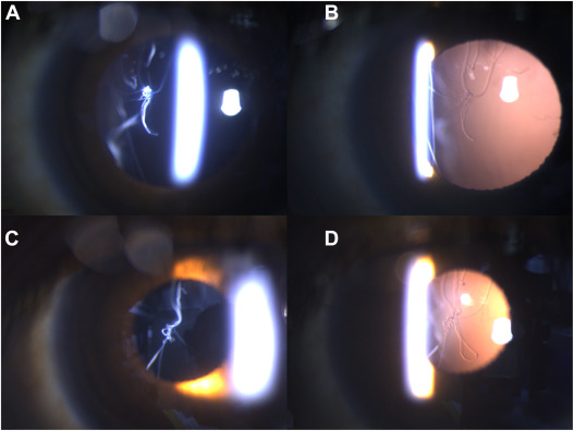 Ophthopedia Update: Vitreous Veils in a Patient with Marfan Syndrome dlvr.it/T67qtS #Ophthalmology #Retina #Ophthotwitter
