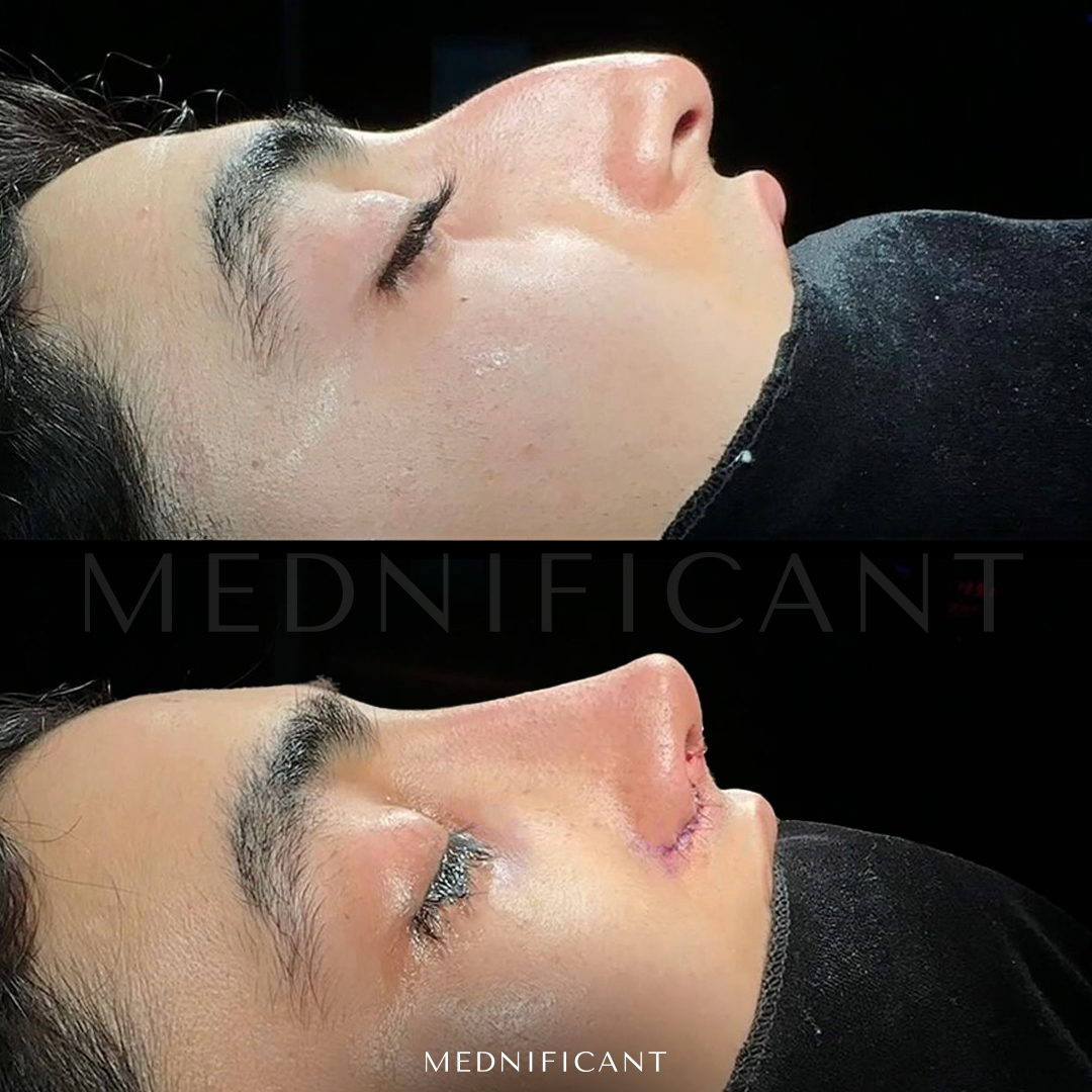 If you are considering getting a nose job, Mednificant Clinic in Istanbul, Turkey is a great option to consider.  

Contact Us For More Through WhatsApp Either  iMessage at: +90 542 177 14 79🇹🇷 

#rhinoplastyspecialist #breastaugmentation #revisionrhinoplasty