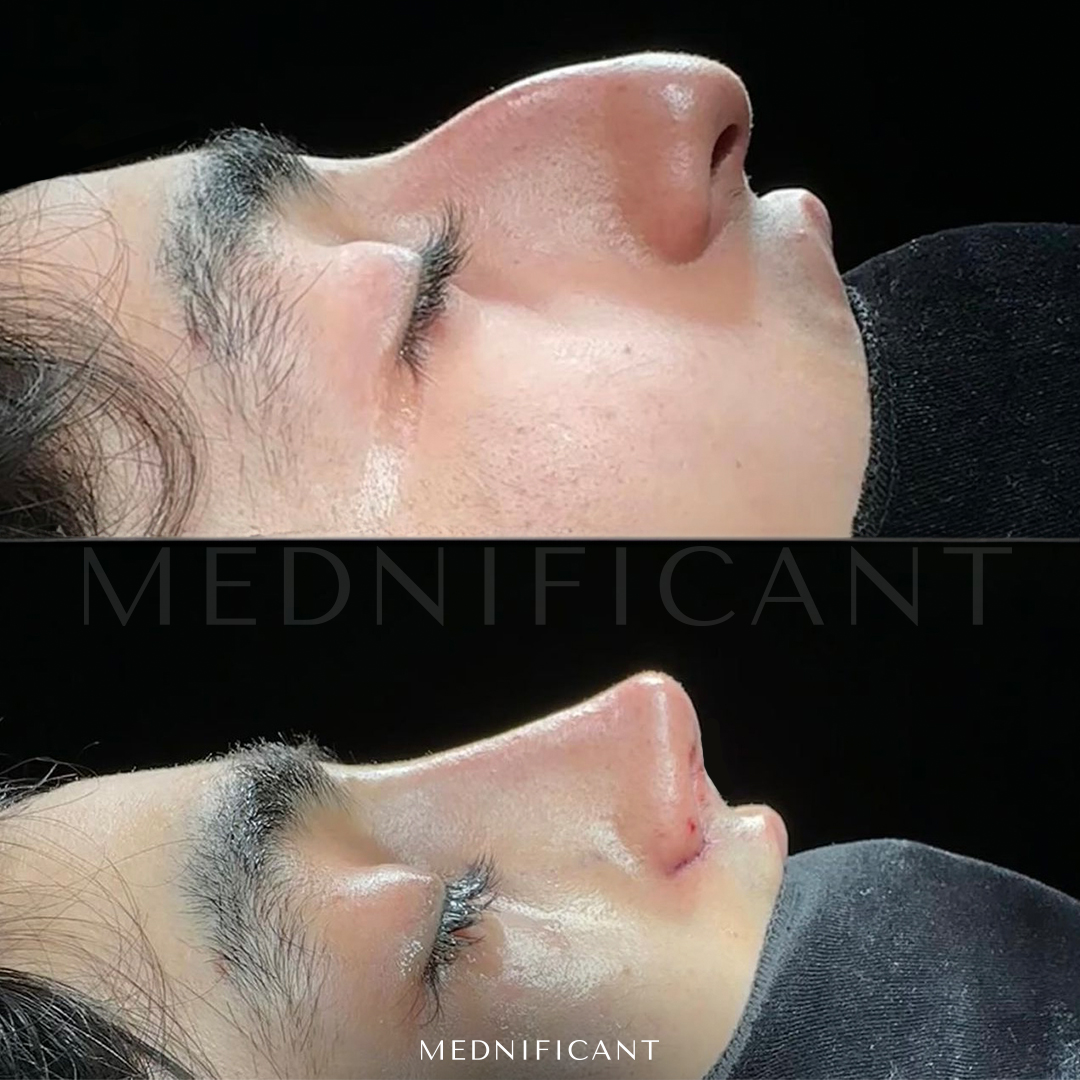 If you are considering getting a nose job, Mednificant Clinic in Istanbul, Turkey is a great option to consider.  

Contact Us For More Through WhatsApp Either  iMessage at: +90 542 177 14 79🇹🇷 

#rhinoplastyspecialist #breastaugmentation #revisionrhinoplasty