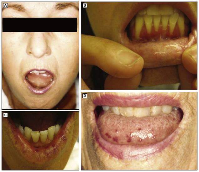 jedo630's tweet photo. Oral manifestations of systemic sclerosis
Oral manifestations.
(A) Perioral skin tightening with decreased oral aperature, furrowing around the lips, and dry membranes.
(B) Periodontal disease with regression of gum and loosening of teeth.
(C, D) Telangiectasias on lips and tongu https://t.co/rriznsPO2L