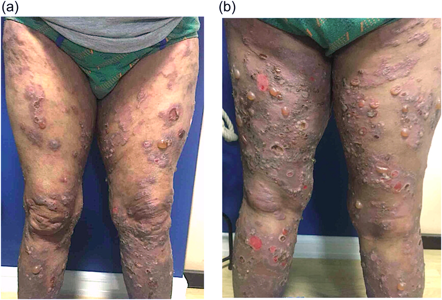 We present a case of new-onset bullous pemphigoid (BP) in a patient with psoriasis following his first booster dose of the #Pfizer #mRNA vaccine.
onlinelibrary.wiley.com/doi/full/10.10…