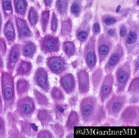 What are these cells & how do you know? Answer: kikoxp.com/posts/3910/ #Pathology #dermpath #dermatology #dermatologia #dermtwitter #pathologists #pathTwitter #histology
