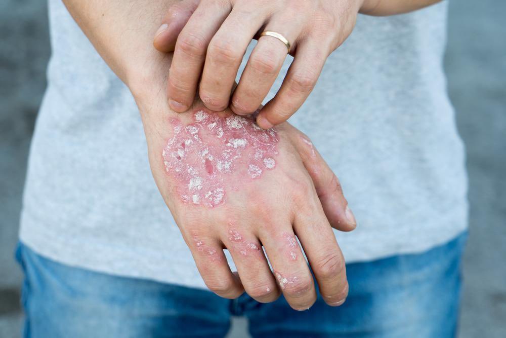 Many people have stated that by going on a low vitamin A diet their eczema, psoriasis or other weird skin issues have gotten better! 

What have you experienced? 

Comment below!