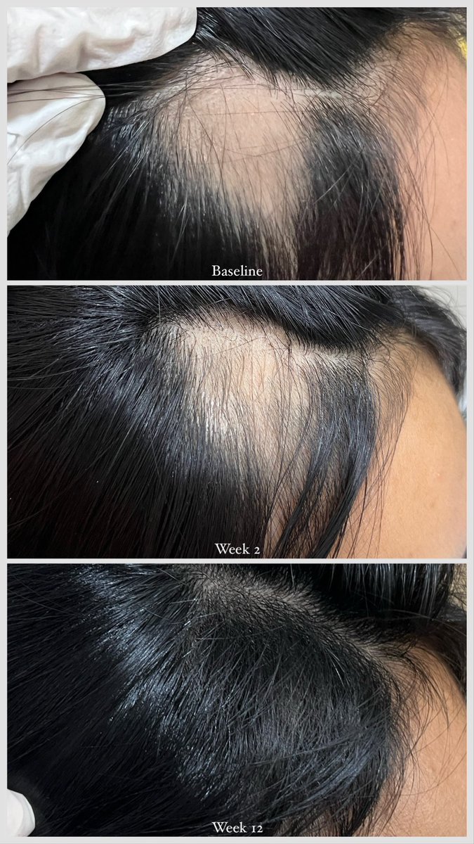 Alopecia areata in an adult female showing great response to topical corticosteroid and minoxidil solution (as precribed and guided by a board-certified dermatologist). ✨

Photos taken at baseline, Week 2, and Week 12.