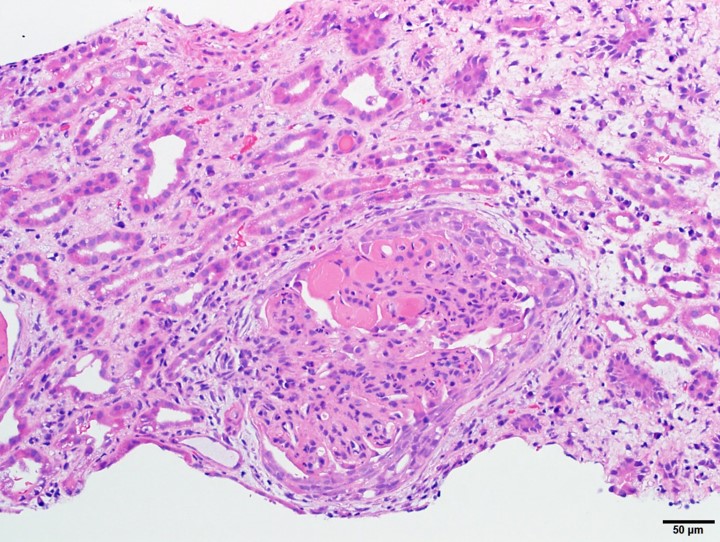 What are the findings of active lupus nephritis in this glomerulus? #renalpath #pathtwitter #pathresidents