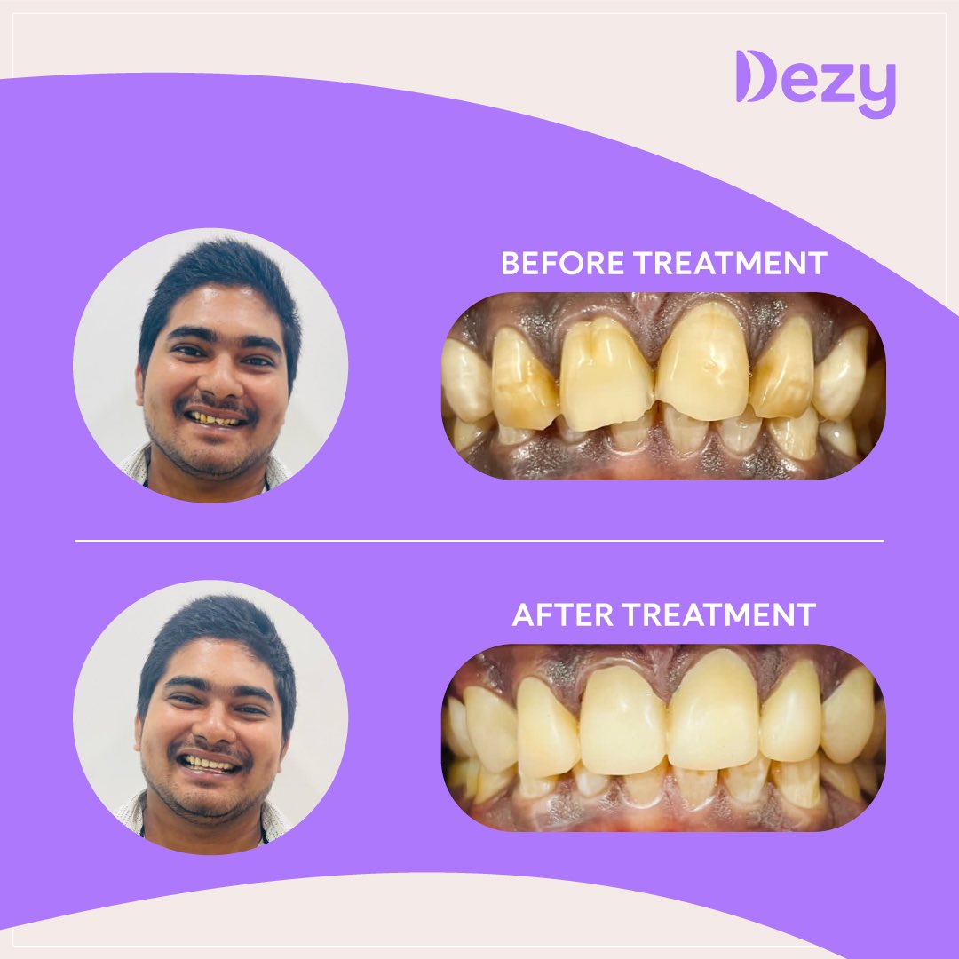 Elevate your smile to shine bright! 💫 Reach out via DM or call 7618792440 to start your smile makeover journey.

#Veneers #SmileMakeover #DentalTransformation #OralHealth #Dezy #DentalCare #DentalTips #OralHygiene #DentalAwareness #IndianDentist