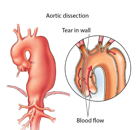 📢 New #reviewpaper/#article Published Online
🙌“RESEARCH TOPIC” Clinical Analysis: Aortic Dissection
🕝 Deadline: 2024.July 30th
🔎 Link: journal.hsforum.com/index.php/HSF/…
#HeartSurgery #AorticDissection