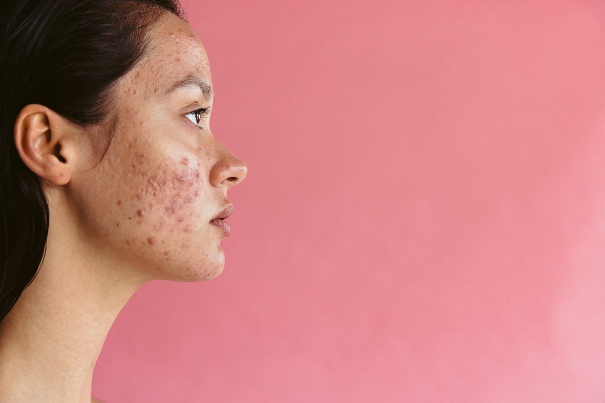 Antioxidant-rich diets linked to better life quality in young women with acne 🍓🥦🌟 news-medical.net/news/20240428/… #AcneCare #WomensHealth #Antioxidants #HealthyEating #NutritionScience #Skincare #QualityOfLife #MentalWellness #DietaryHealth #AcnePrevention