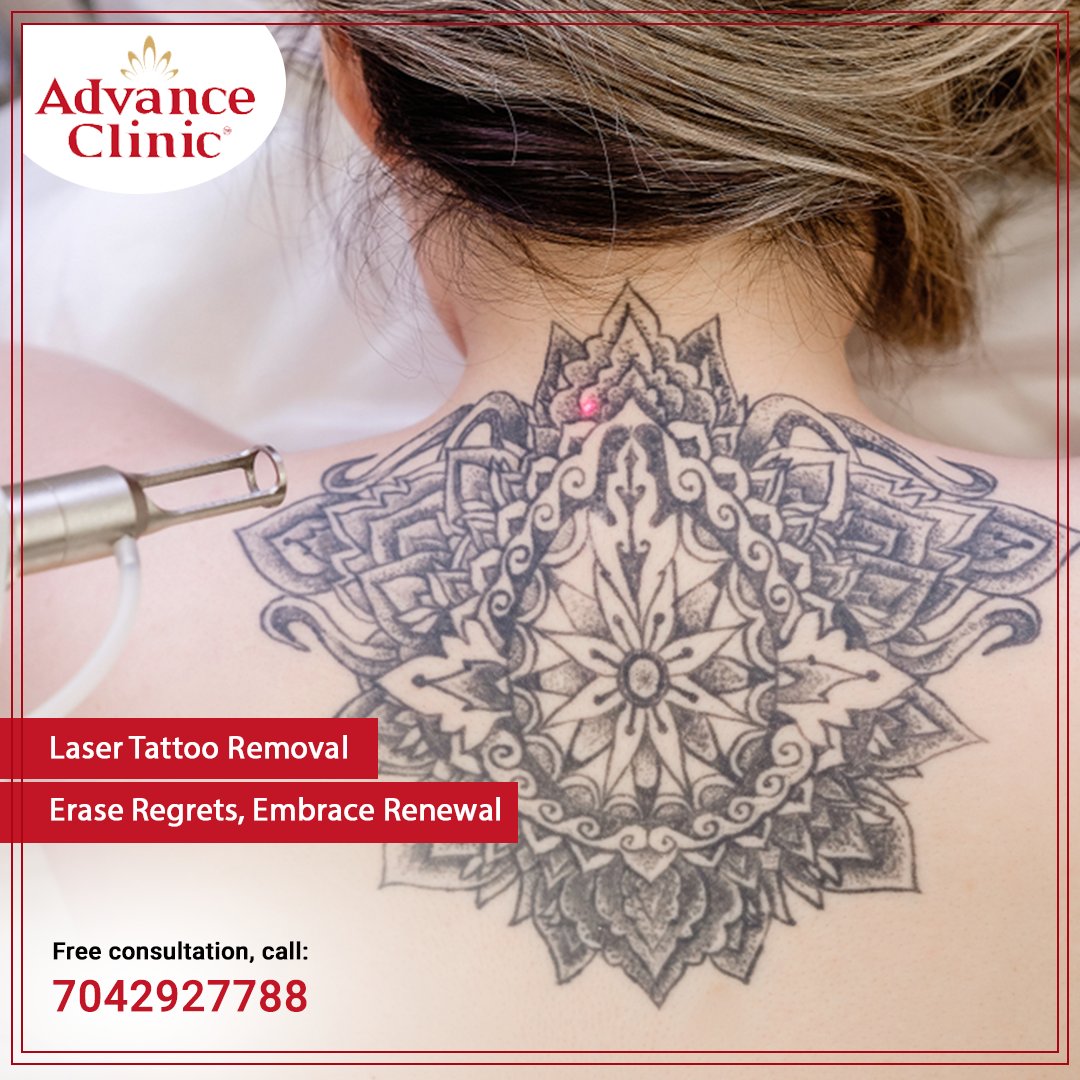 Say goodbye to unwanted ink and hello to a fresh start. Our advanced technology ensures safe and effective removal, leaving your skin smooth and clear. 
For a free consultation, call: 7042927788 or 7042937788.
Book your appointment online: advanceclinic.in/laser-tattoo-r…

#TattooRemoval