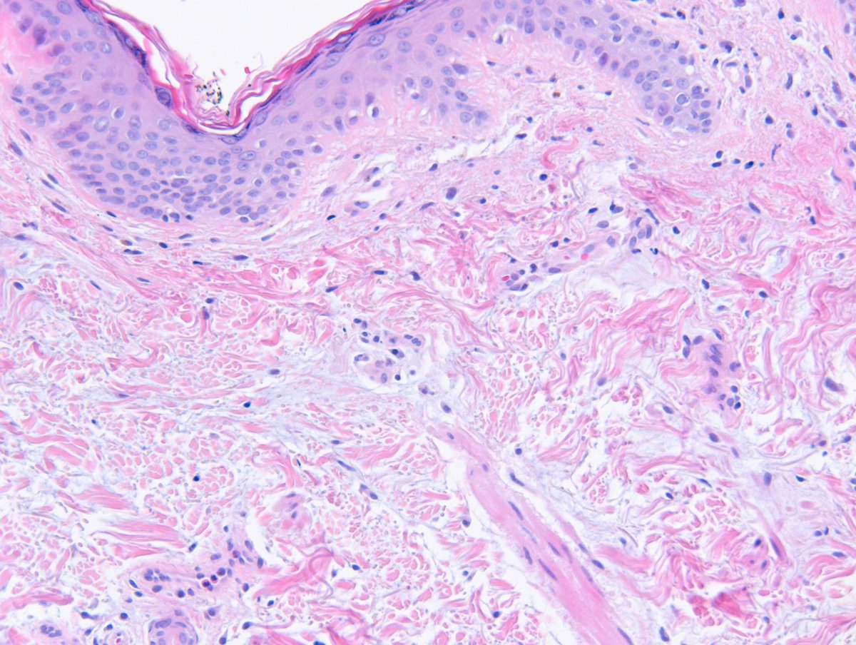 RACARR51's tweet image. 2024 Wk18 RAC9096: F40s, Few years of rash, started erythematous, sun-exposed face, neck, arms, and back of hands, puffiness of fingers. Additional images. Well Done Francisco Bravo who nailed it in one on subtle x400 #SubtleClues #TooCloseToDiagnose #Dermpath