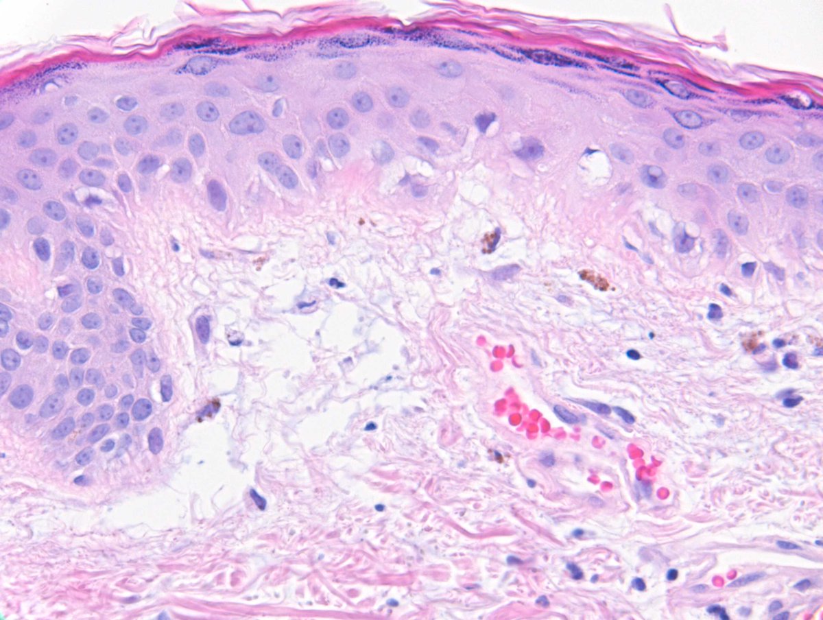 RACARR51's tweet image. 2024 Wk18 RAC9096: F40s, Few years of rash, started erythematous, sun-exposed face, neck, arms, and back of hands, puffiness of fingers. Additional images. Well Done Francisco Bravo who nailed it in one on subtle x400 #SubtleClues #TooCloseToDiagnose #Dermpath