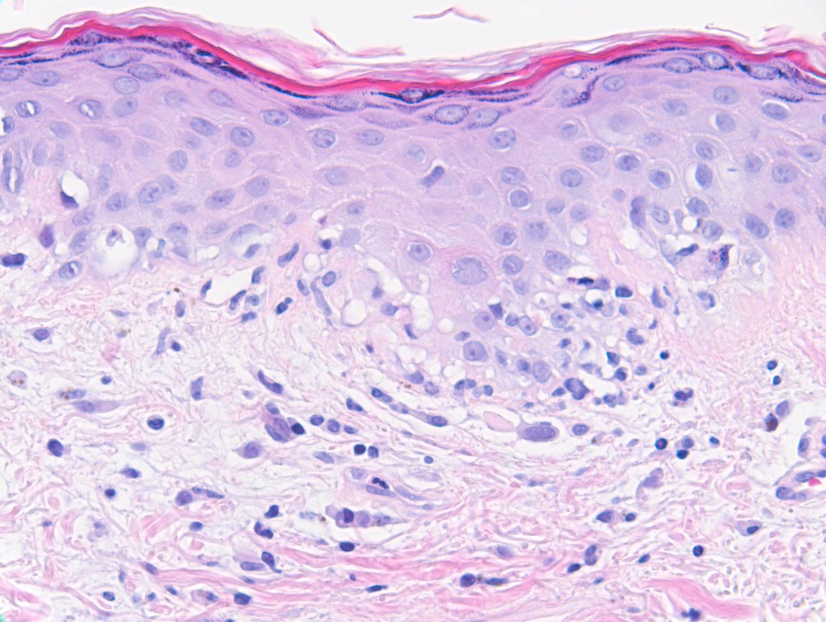 RACARR51's tweet image. 2024 Wk18 RAC9096: F40s, Few years of rash, started erythematous, sun-exposed face, neck, arms, and back of hands, puffiness of fingers. Additional images. Well Done Francisco Bravo who nailed it in one on subtle x400 #SubtleClues #TooCloseToDiagnose #Dermpath