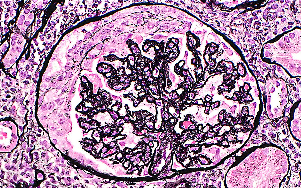 Membranous Nephropathy and Crescent in the same glomerulus (Jones silver stain), in a patient with Lupus ISN/RPS classes III + V. #renalpath #nephrology #kidney #pathology