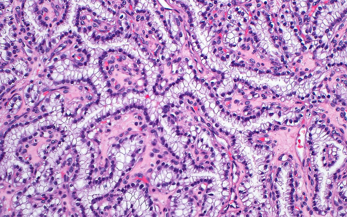 Clear Cell Papillary Renal Cell Tumor ~ #GUpath #pathology