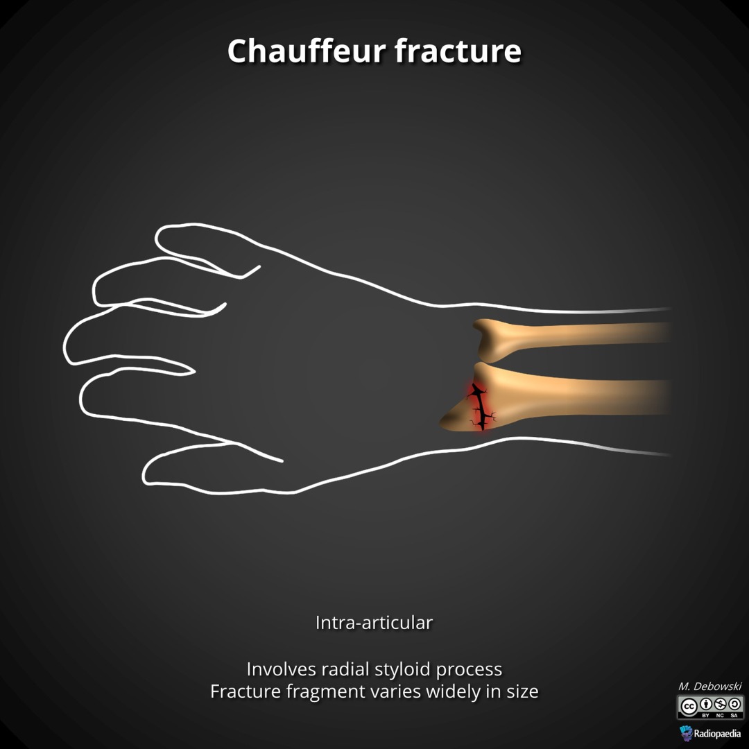 Chauffeur fractures (also known as Hutchinson fractures or backfire fractures) are intra-articular fractures of the radial styloid process. The radial styloid is within the fracture fragment, although the fragment can vary markedly in size.

#OrthoTwitter