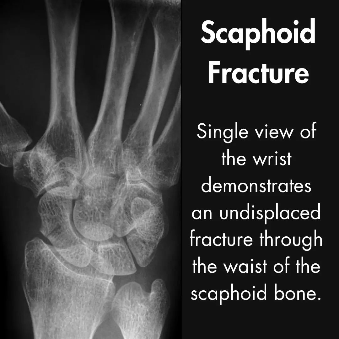 Scaphoid fractures account for 70-80% of all carpal bone fractures

Case: radiopaedia.org/cases/scaphoid…

#OrthoTwitter #Orthopaedics