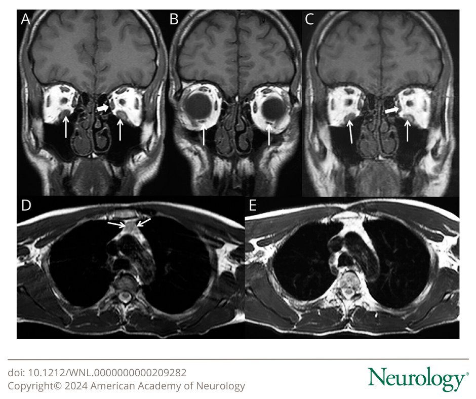 Pearls & Oy-sters: Thyroid-Associated Ophthalmopathy and Transient Neuromuscular Junction Disorder Due to Graves Disease bit.ly/3PT9mxs

#NeurologyRF #NeuroTwitter