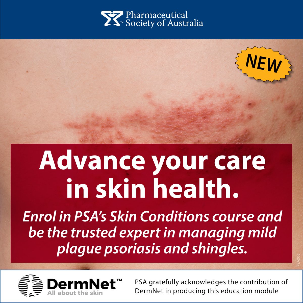 Dive into @PSA_National's newly launched course Mild Plaque Psoriasis & Herpes Zoster (Shingles) Essential training for pharmacists participating in the Victorian Statewide Pilot This is your gateway to becoming a leader in community health. Enrol now! loom.ly/kw28mbY