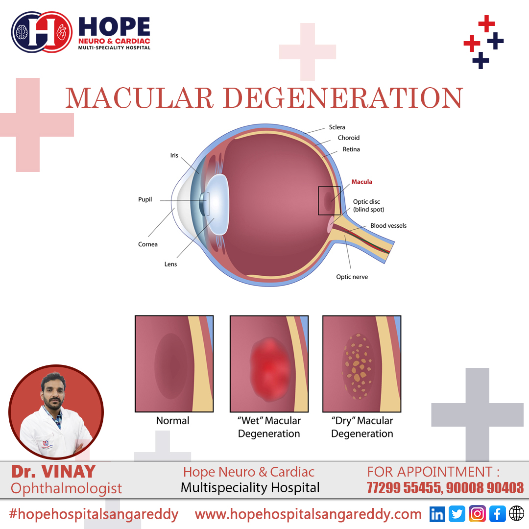 Hope Neuro & Cardiac Multispecialty Hospital
Dr. Vinay
Ophthalmologist
Appointment : 7729955455
#sangareddy #SangareddyDist #eyes #eyemakeup #cataractsurgery #cataractsurgerysuccess