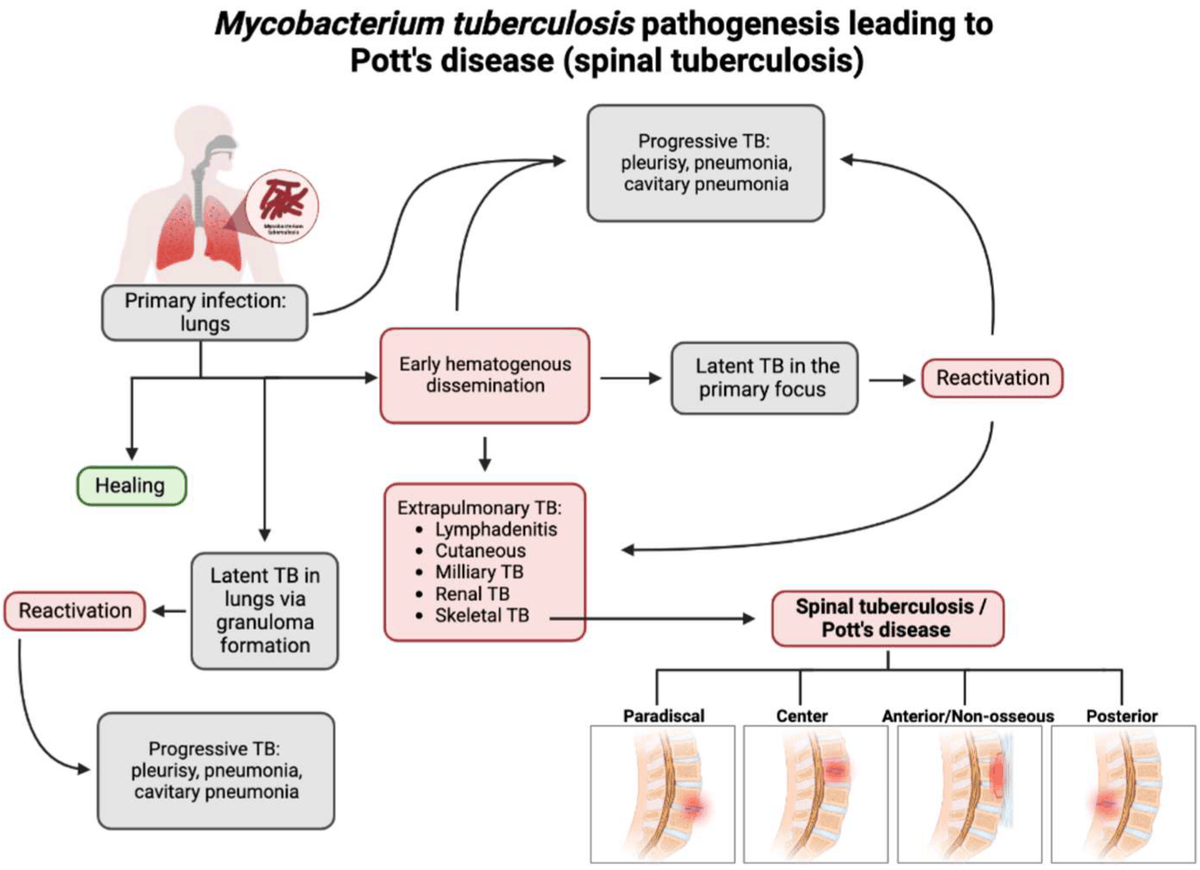 @ladyspinedoc Mycobacterium tuberculosis ➡️ Pott's disease/tuberculous spondylitis.

Pathogenesis of Pott’s disease 👇🏼

<Image source: Clin. Pract. 2023, 13(1), 155-165; doi.org/10.3390/clinpr…>