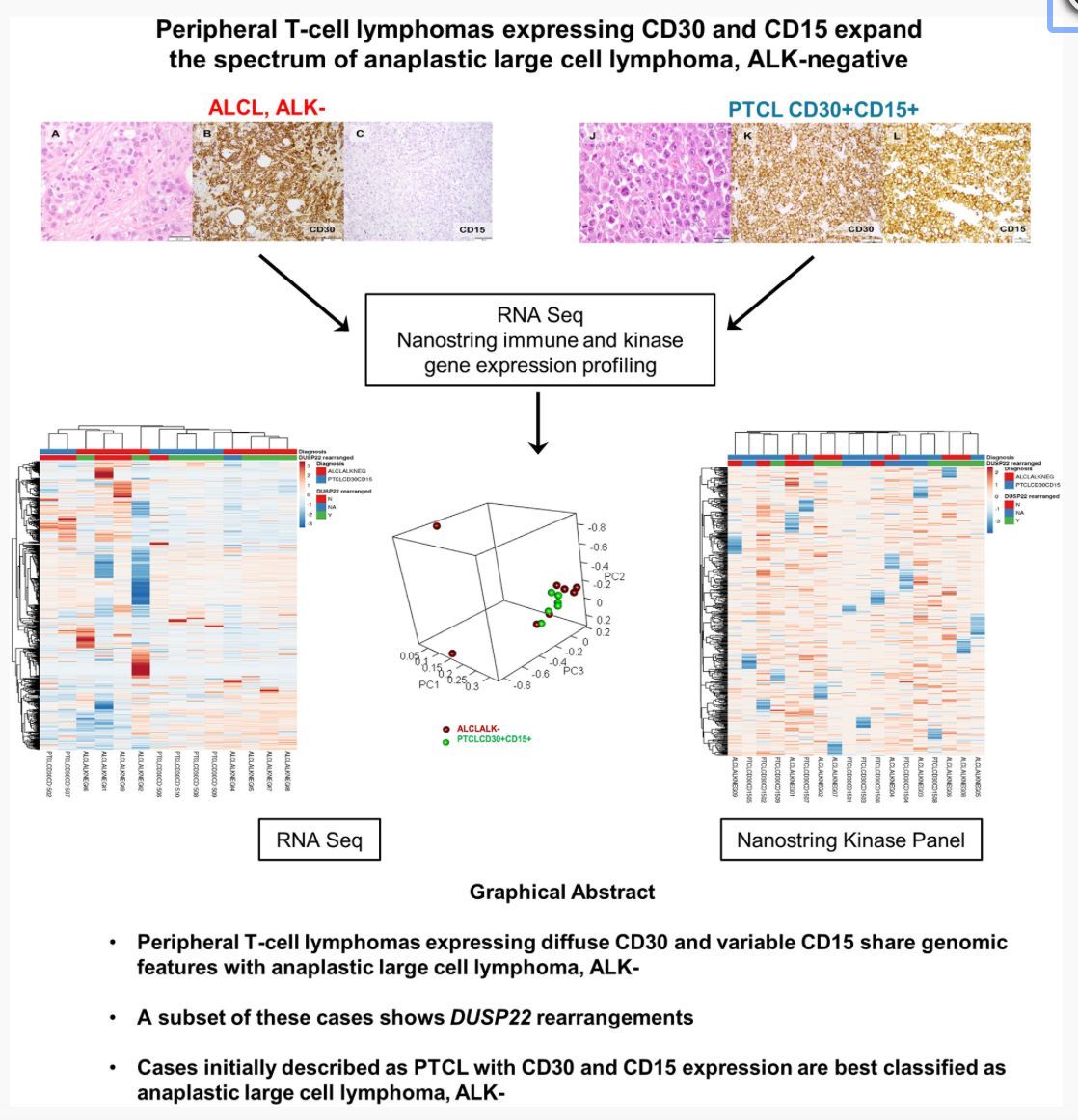 Peripheral T-cell lymphomas expressing CD30 and CD15 expand the spectrum of anaplastic large cell lymphoma, ALK-negative buff.ly/3w1cvEF