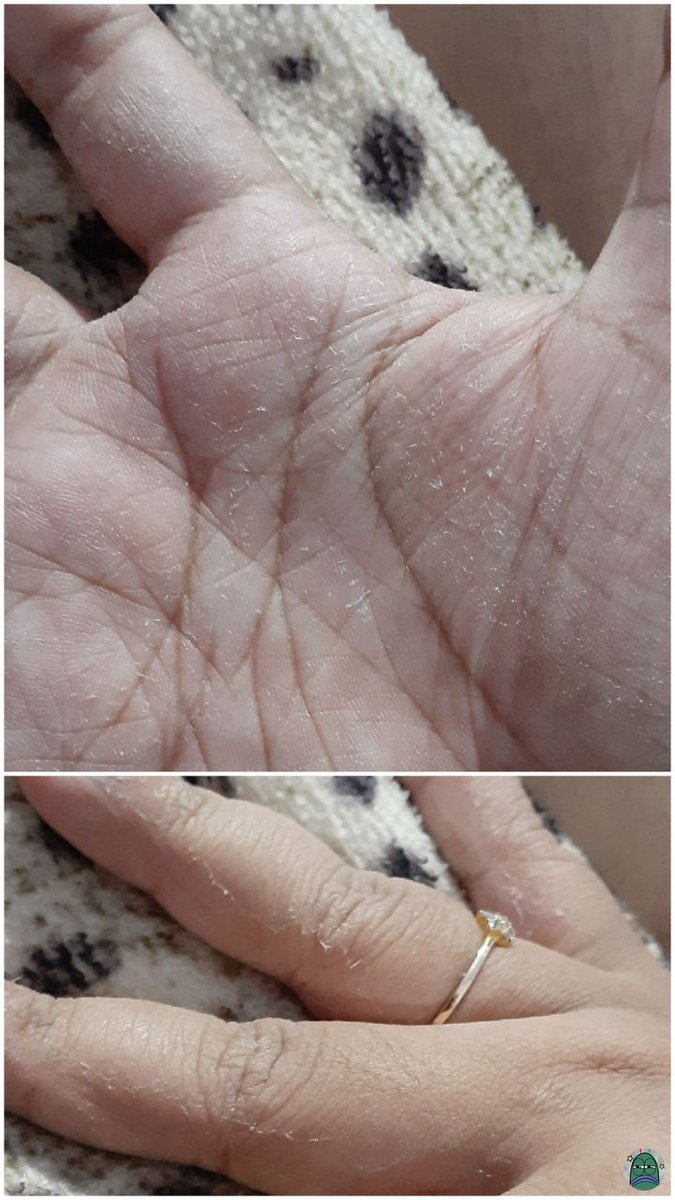 tanyarlfes's tweet photo. GUYS WTA ini ada yg tau ga kenapa tiba2 ngelentek gini, ga sakit, cuma di tangan kanan aja thx! 💚 https://t.co/SOu0NGuLND