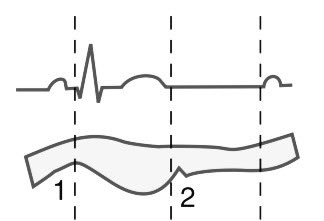 #POCUS #MedTwitter 🔶 Septal motion on M-Mode 1/ 📌 Normal pattern:- ✅ Systole - brief anterior motion (1) followed by posterior motion and myocardial thickening ✅ Diastole - small diastolic dip (2) following mitral valve opening