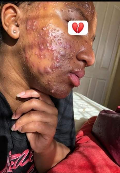 buchim33's tweet photo. Look at what bleaching cream has done to this beautiful face https://t.co/bV1pyGRkpn
