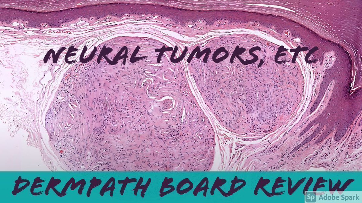 Neural Tumors, etc: #Dermpath Board Review video (25 classic cases in 1.5 hrs) kikoxp.com/posts/4999 for #pathologists #pathology #pathTwitter #dermatology #dermatologia #dermtwitter. Pigmented NF, perineurioma, schwannoma, neurothekeoma, nerve sheath myxoma, and more! Enjoy!