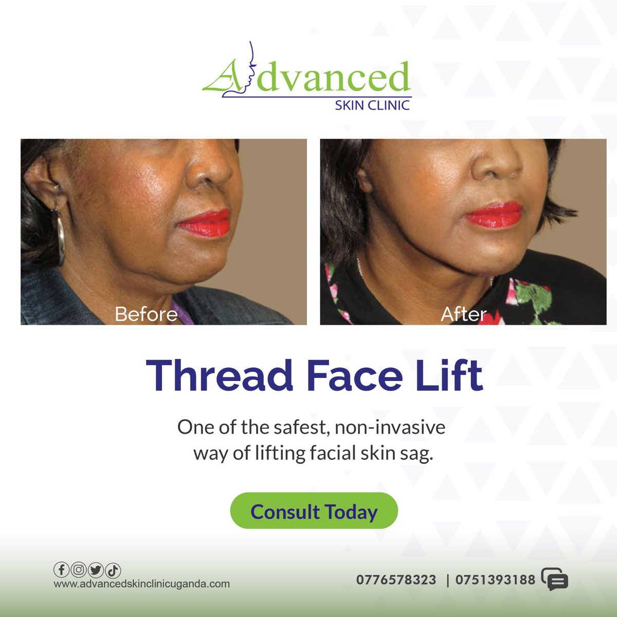 The thread lift is a minimally invasive cosmetic treatment that corrects aged or sagging skin.

Visit us for your treatment!

advancedskinclinicuganda.com/thread-lift/

#threadlift #skincare